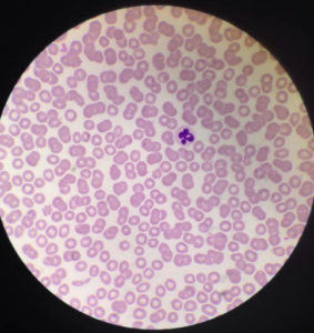 Immunotherapy Treatment