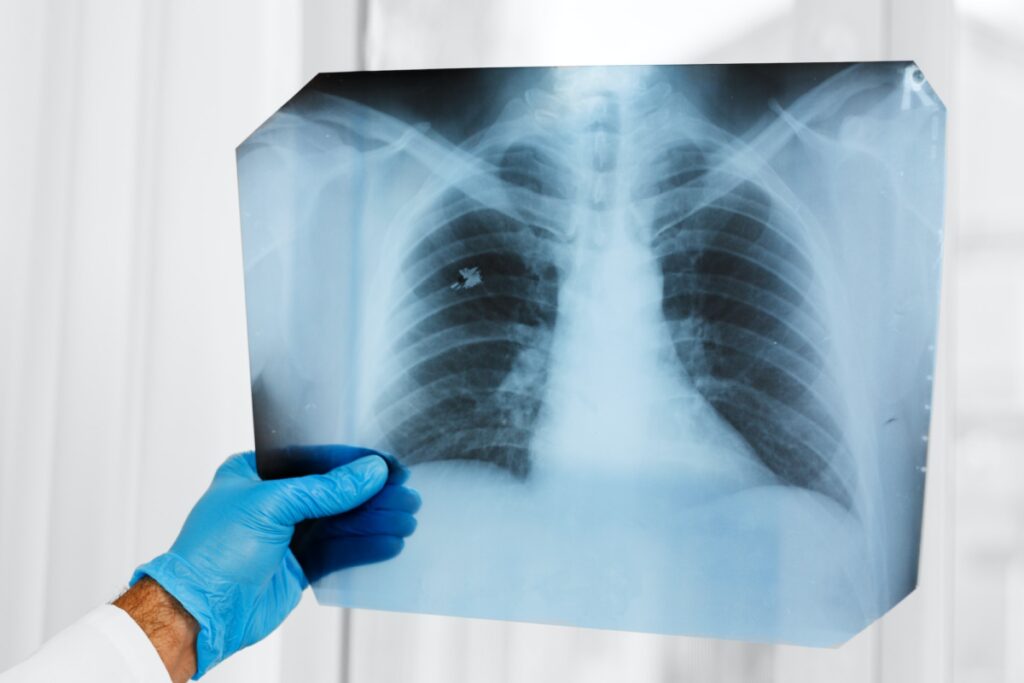 Alternative Lung Cancer Treatment Brain Metastasis Disappear Hydrogen Inhalation